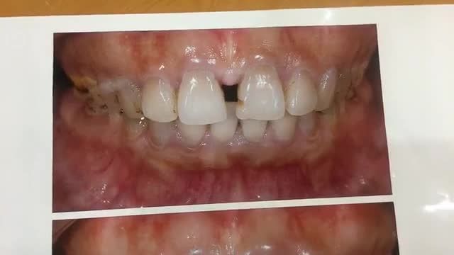 Trực tiếp gắn cố định 2 mặt dán sứ veneer cho chị khách hàng tại Nha Khoa Thuỳ Anh.