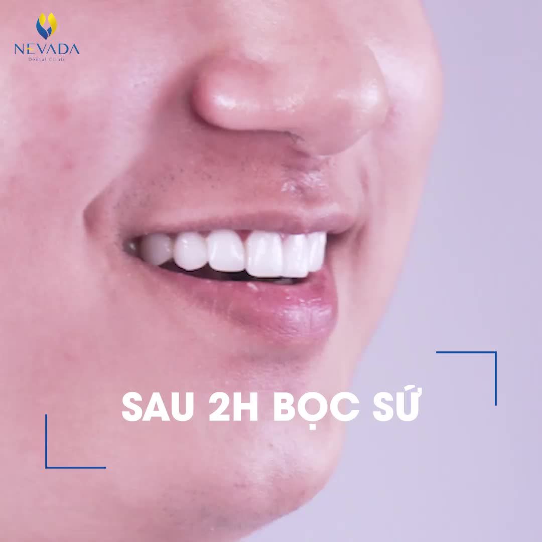 THỬ THÁCH CẮN TÁO SAU KHI BỌC SỨ, ĐIỀU GÌ SẼ XẢY RA
