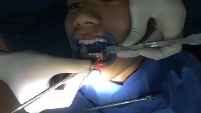 Gắn mắc cài cho bạn Hoà.1 bộ mắc cài thông minh.
