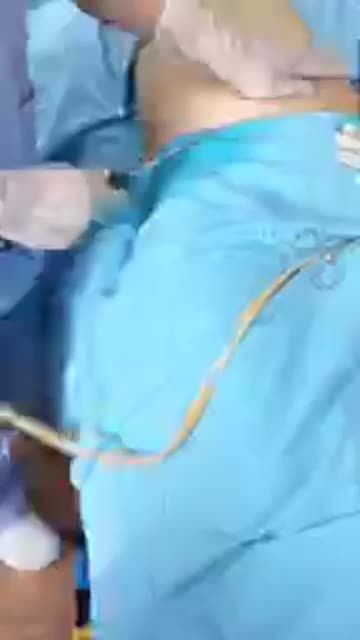 quá trình hút mỡ tạo sinh tố xoài bằng công nghệ Vaser lipo Dr Hoàng Tuấn