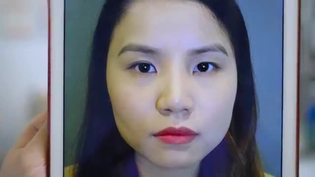 Mắt nhỏ mí lót khắc phục như thế nào và cải thiện được bao nhiêu % sau cắt mí Mani Open Deep 5D