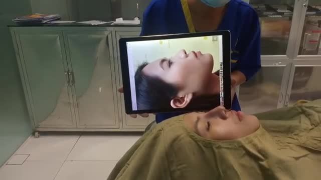 Khách hàng vừa nâng mũi Silver Line tại Dr.Tống Hải