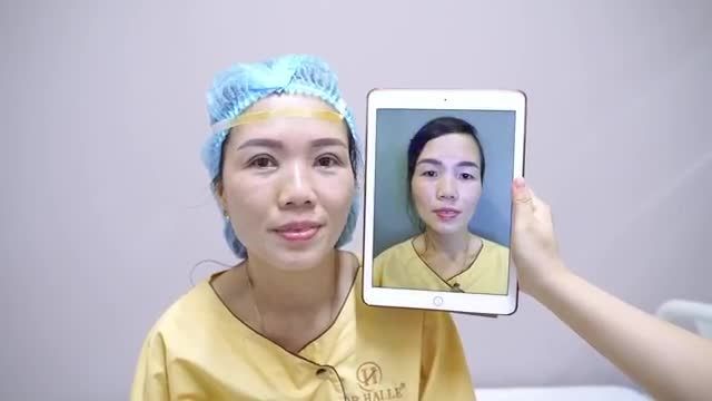 Trẻ hóa đôi mắt nhờ Cắt mí Mani Open Deep 5D Chỉ với 15 phút đã "cải lão hoàn đồng" thành công cho vị khách hàng đến từ Hải Dương