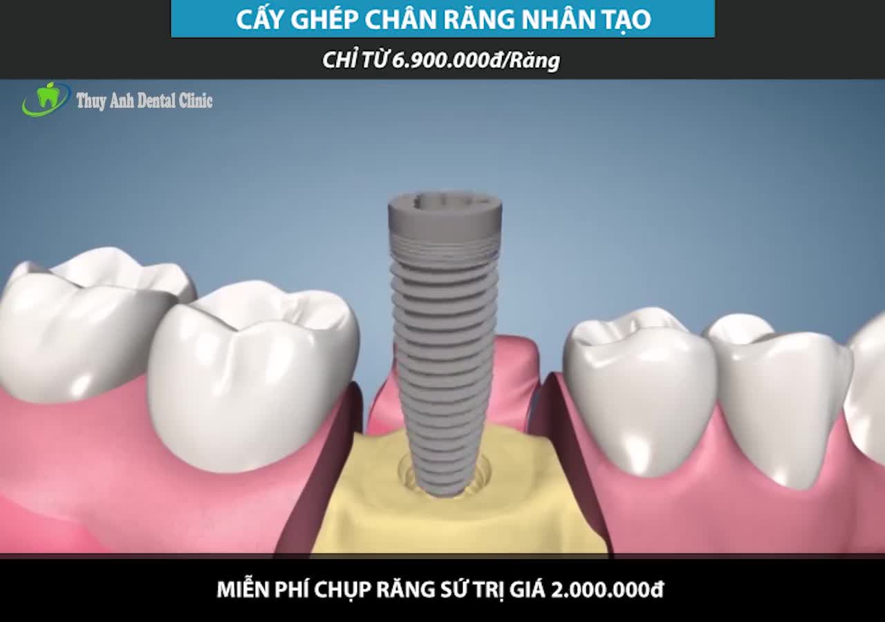 TRỒNG RĂNG GIẢ TỐT NHẤT HIỆN NAY LÀ IMPLANT