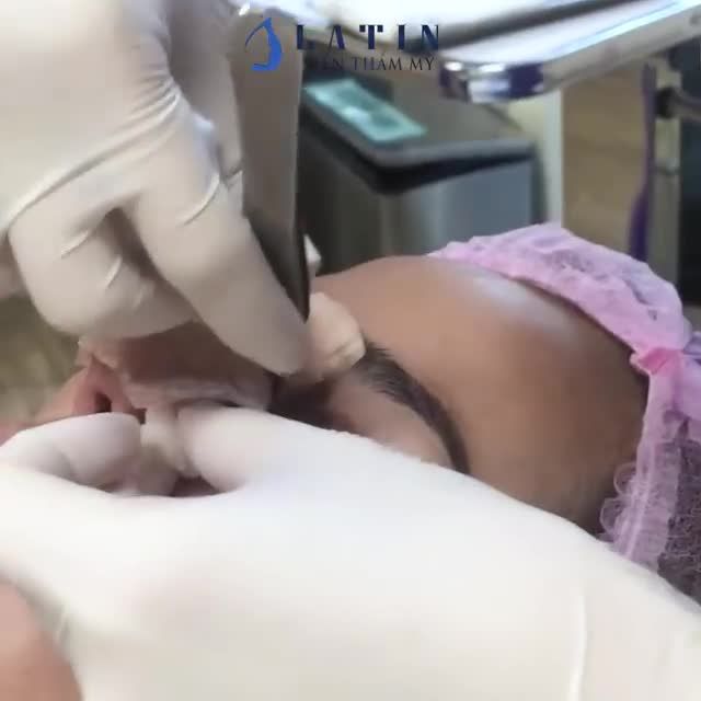 COMBO MŨI + MÍ SAU 7 NGÀY CẮT CHỈ - Đẹp miễn chê