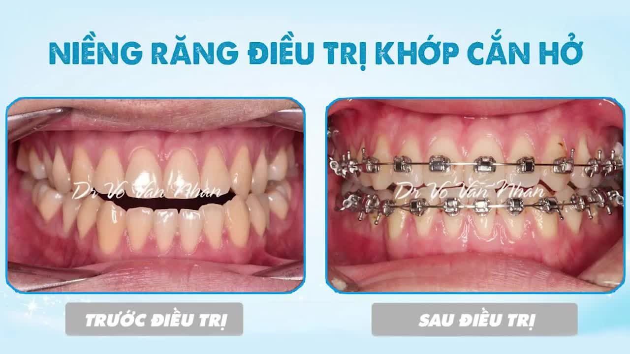 Răng thưa, răng móm, răng hô  Hễ mà lệch lạc mời vô để niềng