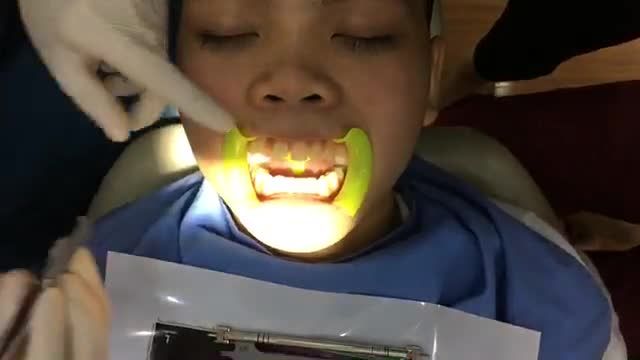 GẮN MẮC CÀI TẠI NHA KHOA THÙY ANH