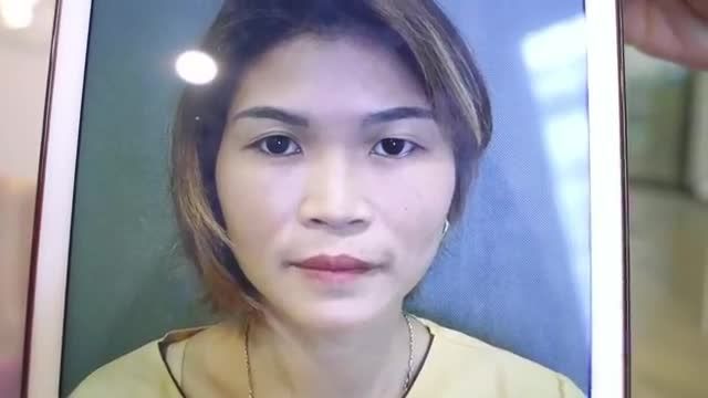 Kết quả cắt mí Mani Open Deep đẹp hút hồn, vừa thực hiện xong. Cùng xem sự thay đổi của chị gái