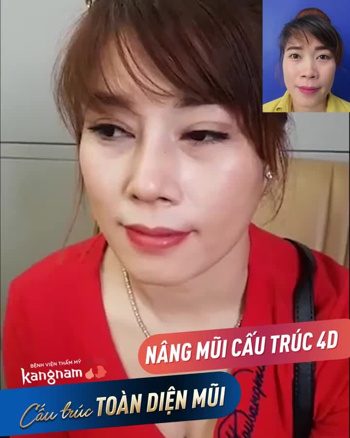 Nâng mũi Cấu trúc 4D - Chia tay MŨI THẤP TẸT - Có ngay MŨI CAO TÂY chỉ 60P