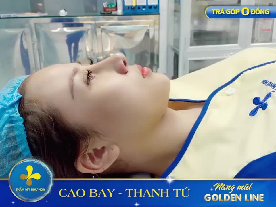 CHÀO ĐÓN SIÊU PHẨM MŨI GOLDEN LINE VỪA RA ĐỜI TẠI PHÒNG TIỂU PHẪU DR TỐNG HẢI