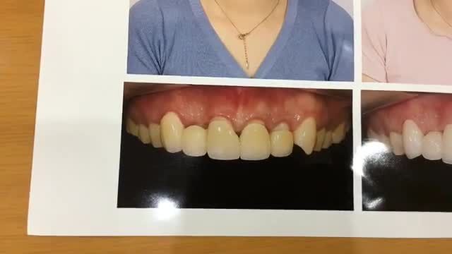 gắn cố định răng sứ cho chị Hiền.