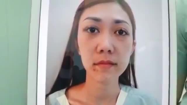 SỬA MŨI HỎNG THÀNH MŨI XINH – ĐẸP NGAY SAU 60 P