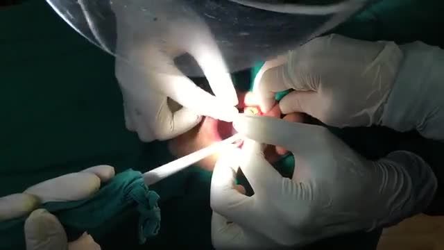cấy 2 implant:1 răng nhổ và cắm tức thì cho chú Minh. Bác sĩ thực hiện: Dr. Lê Sơn Tùng
