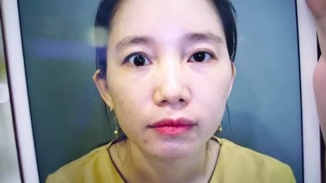Ngỡ ngàng sau khi soi gương không nhận ra mình sau khi cắt mí Mani Open Deep 5D