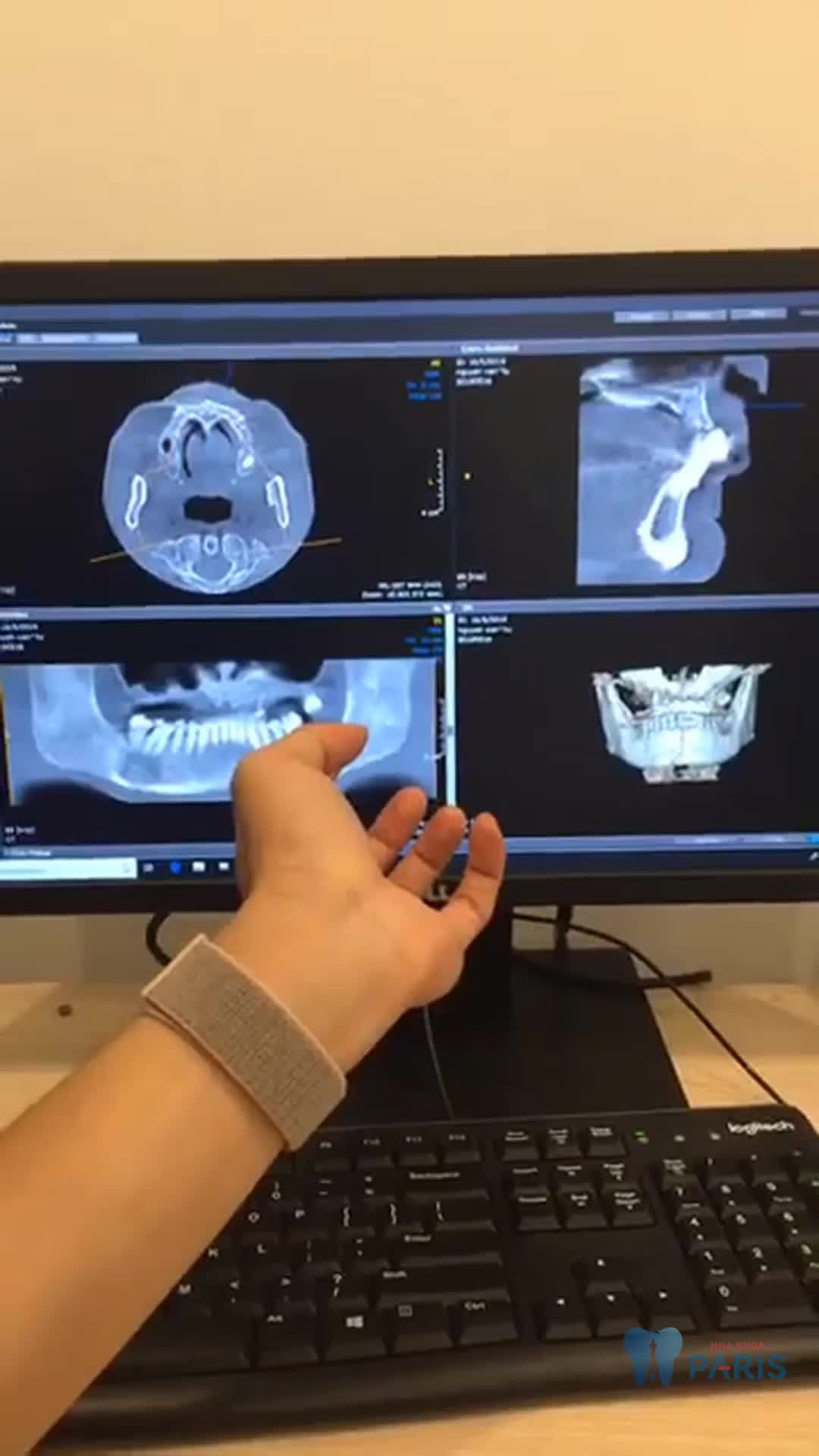 CẢM NHẬN CỦA KHÁCH HÀNG SAU TRỒNG RĂNG IMPLANT