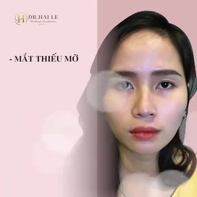 ĐÔI MẮT TƯƠI TRẺ - THAY ĐỔI THẦN THÁI