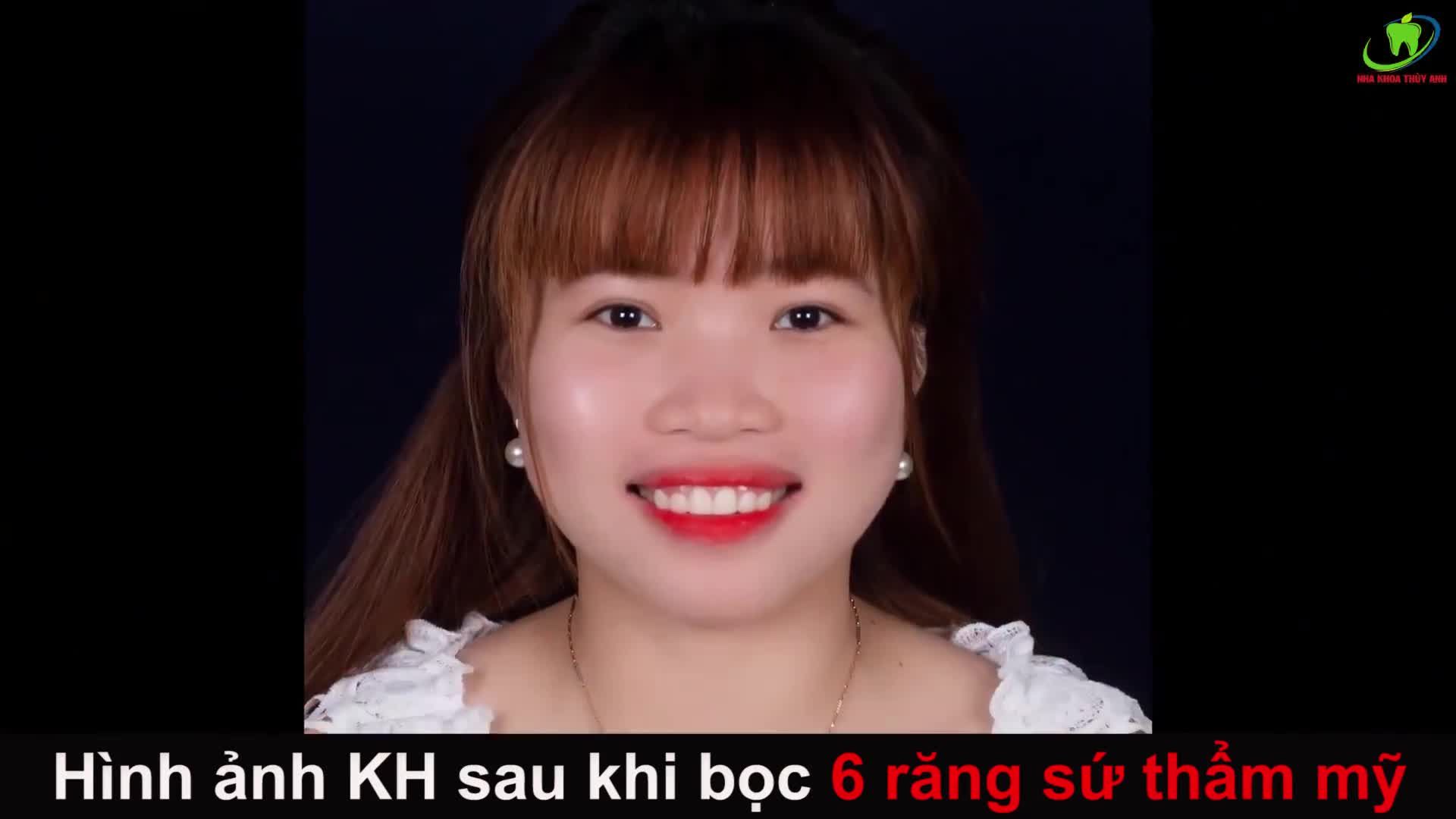 TẤT CẢ KHÔNG CÒN NỖI LO SỢ KHI ĐẾN VỚI NHA KHOA THÙY ANH
