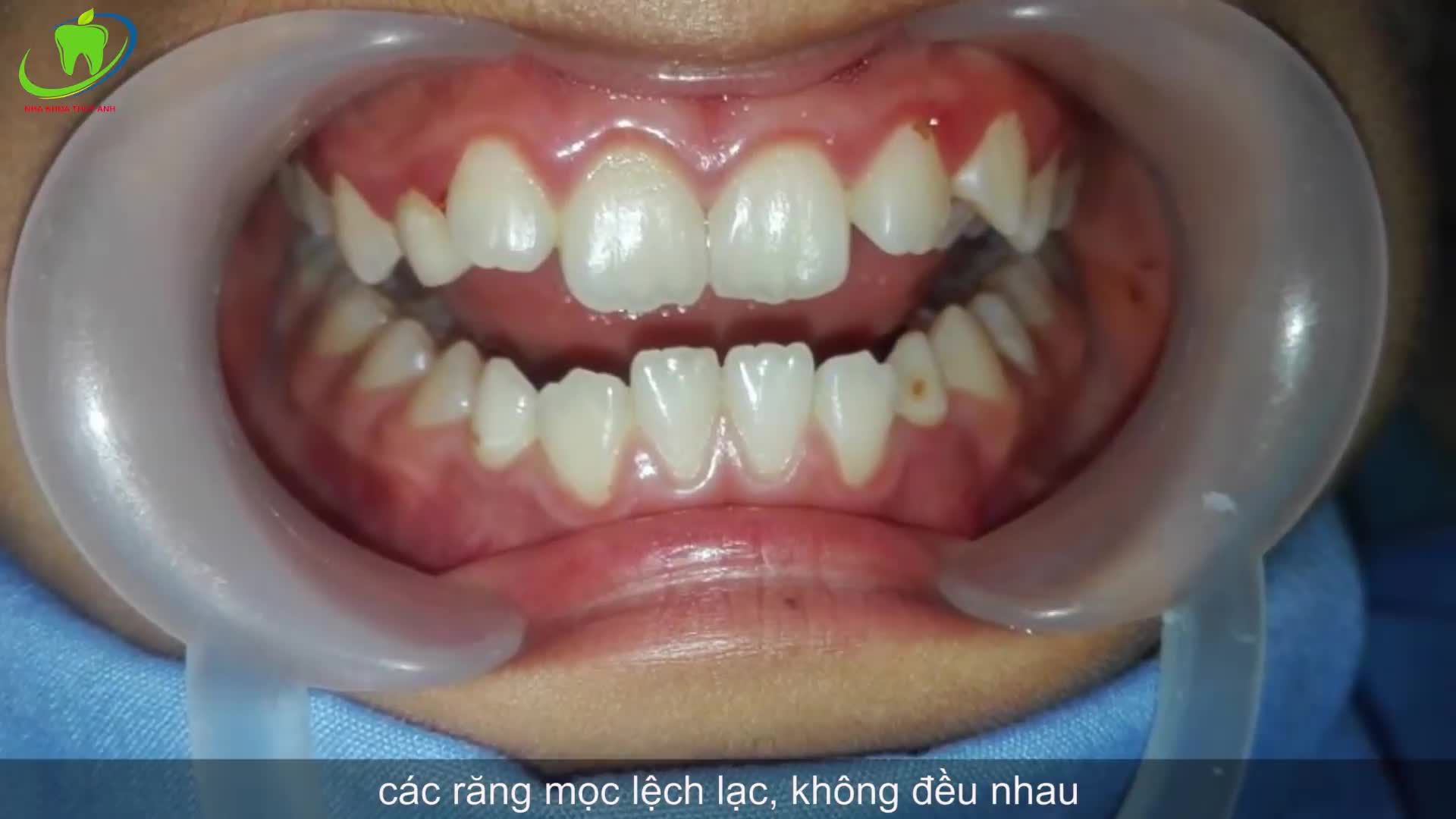ĐÁNH THỨC NỤ CƯỜI BẰNG PHƯƠNG PHÁP NIỀNG RĂNG