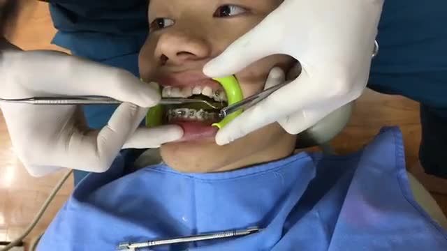 gắn mắc cài hàm trên cho bạn Hoà.