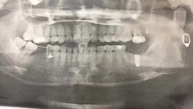 Cấy implant tại Nha Khoa Thùy Anh.