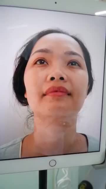 NÂNG MŨI THAY ĐỔI CẢ KHUÔN MẶT - 45 PHÚT SỞ HỮU NGAY MŨI ĐẸP