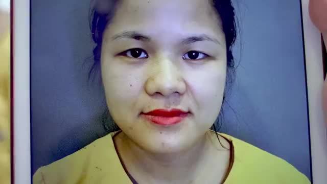 Cùng chiêm ngưỡng sự thay đổi hoàn hảo của khách hàng sau khi cắt mí Mani Open Deep 5D tại Dr.Hải Lê