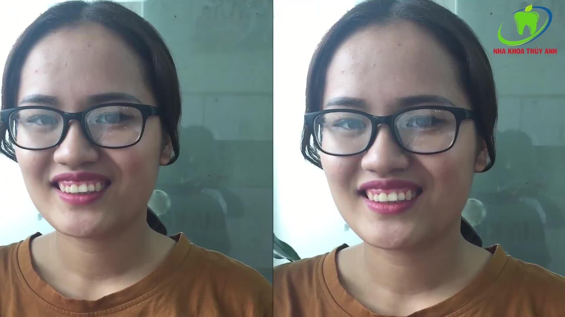 NÂNG TẦM NHAN SẮC BẰNG PHƯƠNG PHÁP PHẪU THUẬT CƯỜI HỞ LỢI