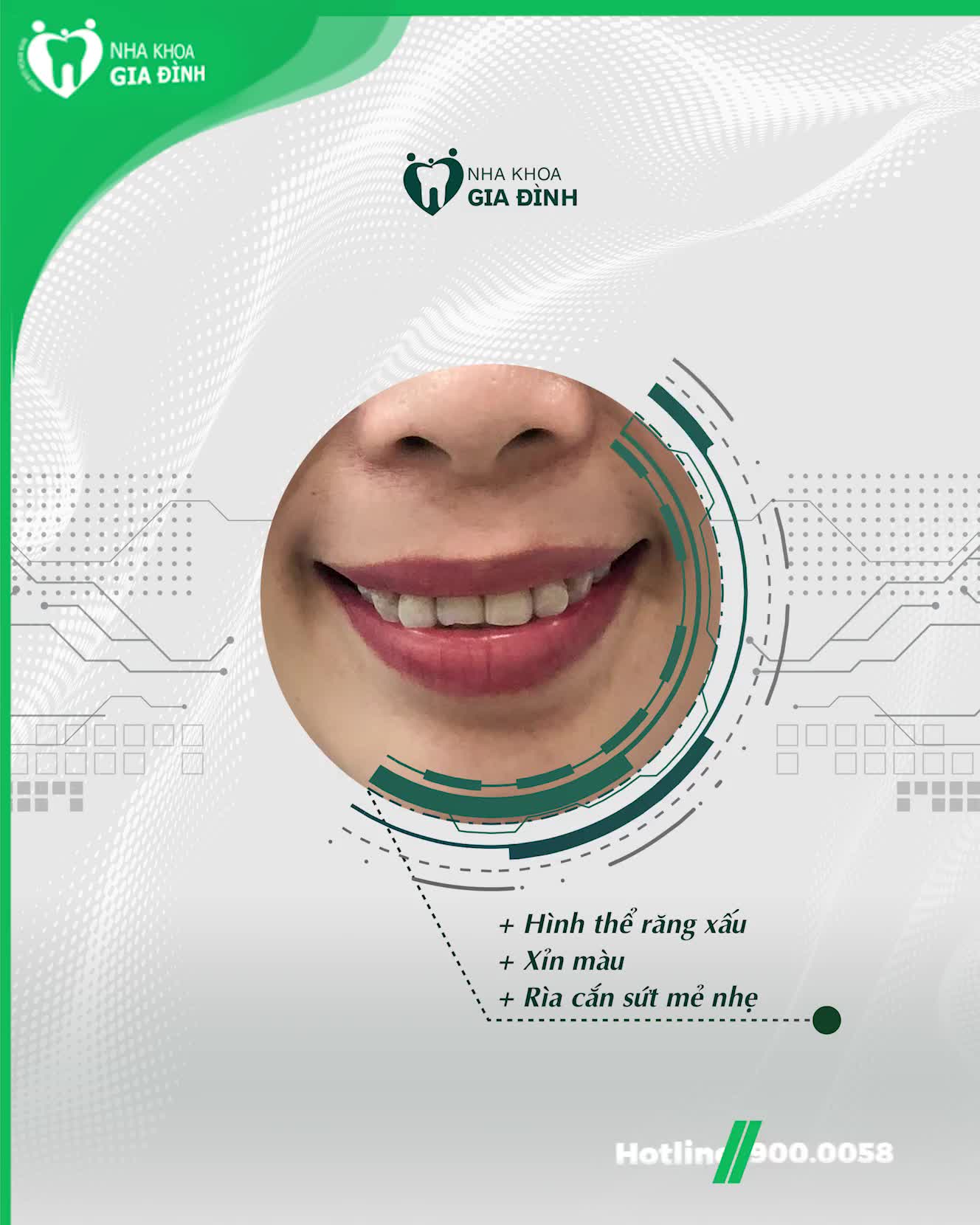 Chị Thu Phương chia sẻ: hàm răng mới được kiến tạo bởi bác sĩ Nha khoa Gia Đình hơn cả sự mong đợi của chị.
