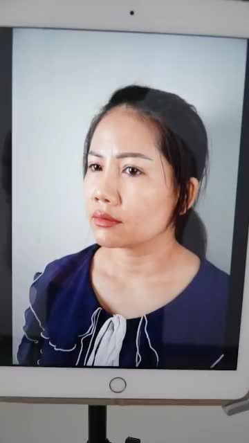 KHÁCH THÁO NẸP SAU 7 NGÀY NÂNG MŨI CẤU TRÚC SỬA LẠI