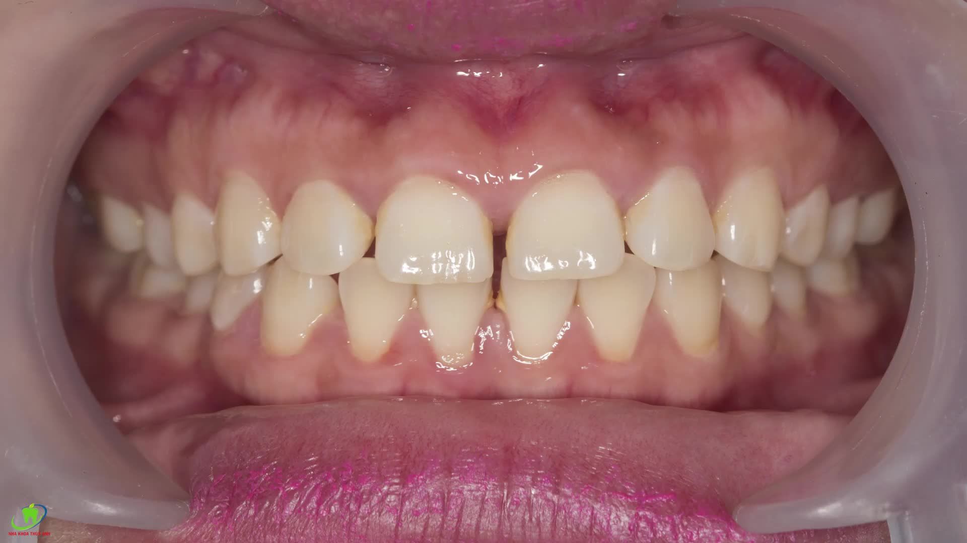 CHỈ VỚI 4 MẶT DÁN SỨ VENEER TẠO RA NỤ CƯỜI HOÀN HẢO HƠN