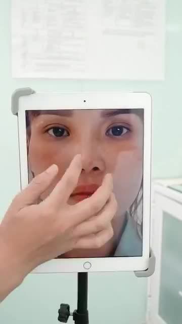 KHẮC PHỤC HOÀN TOÀN KHUYẾT ĐIỂM MŨI LỘ SÓNG, BÓNG ĐỎ