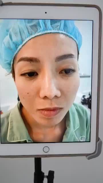 MŨI CẤU TRÚC SỬA LẠI SAU 8 NGÀY