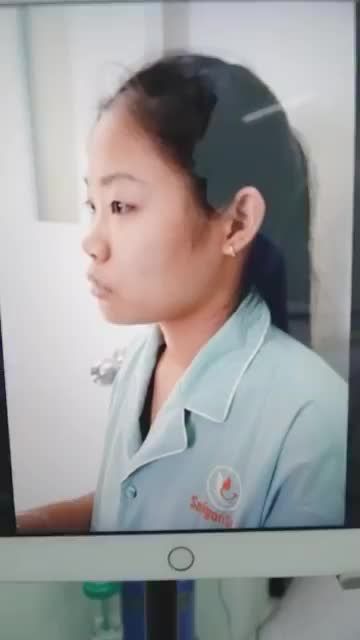 CHỈ 45P NÂNG MŨI CẤU TRÚC - BẠN ẤY TRÔNG XINH ĐẸP VÀ CUỐN HÚT HƠN RẤT NHIỀU