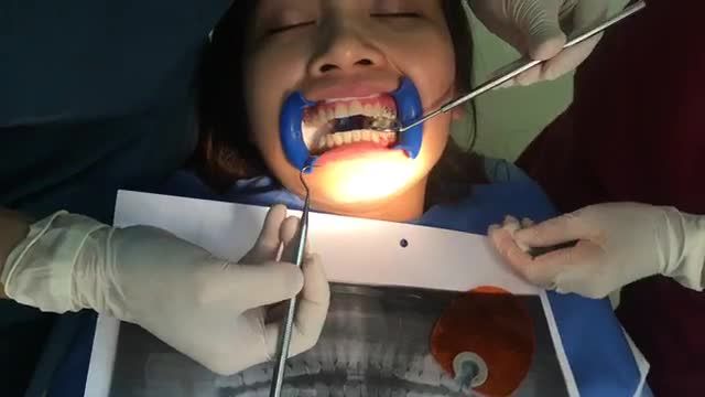 GẮN MẮC CÀI TẠI NHA KHOA THÙY ANH