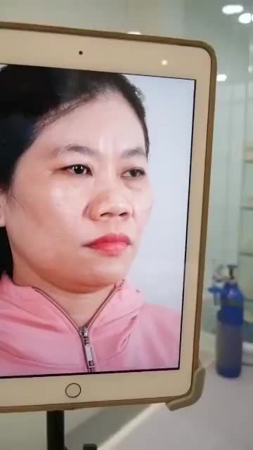 45P TẠO NÊN SỰ THAY ĐỔI LỚN – VỚI PP NÂNG MŨI CẤU TRÚC TẠI DR HOẠT