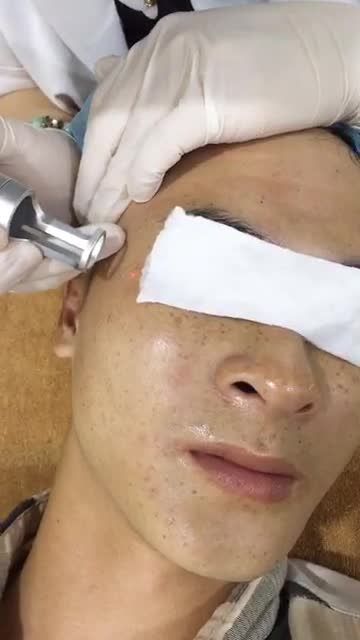 Không chỉ Nữ giới mà Nam giới cũng bị ám ảnh bởi Tàn nhang