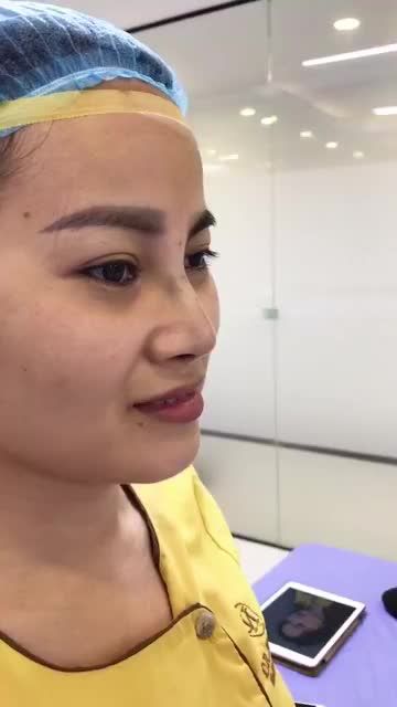 lột xác với chỉ trong 1h với chiếc mũi cao tây tự nhiên sau khi nâng mũi Demi 5D đẹp hoàn hảo mọi góc độ