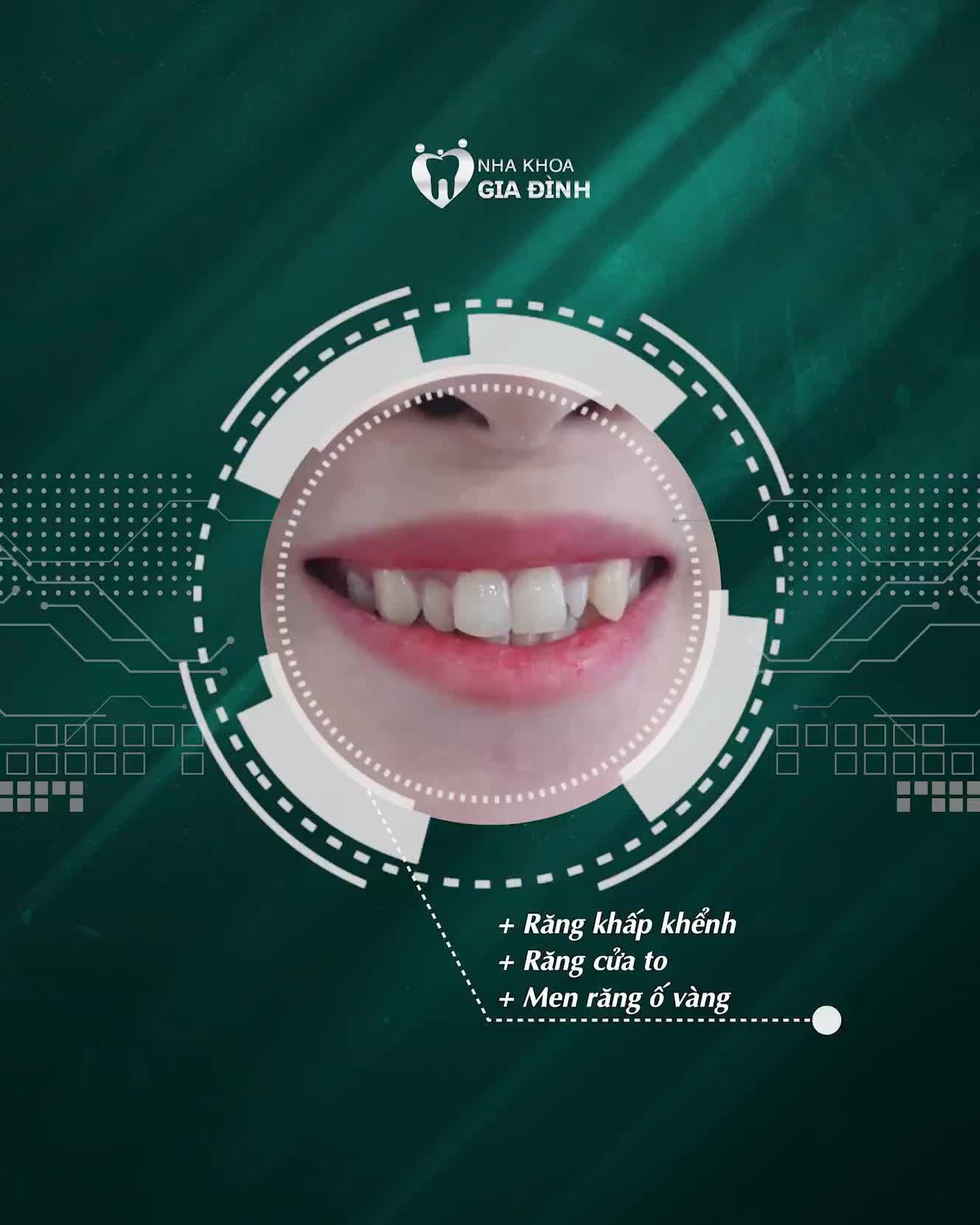 “SÁNG CẢ GƯƠNG MẶT” SAU KHI THẨM MỸ 14 RĂNG SỨ E.MAX