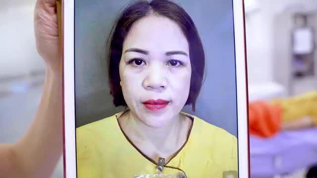 Kết hợp cùng lúc các dịch vụ: Cắt mí dưới + Nâng cung + Nâng mũi