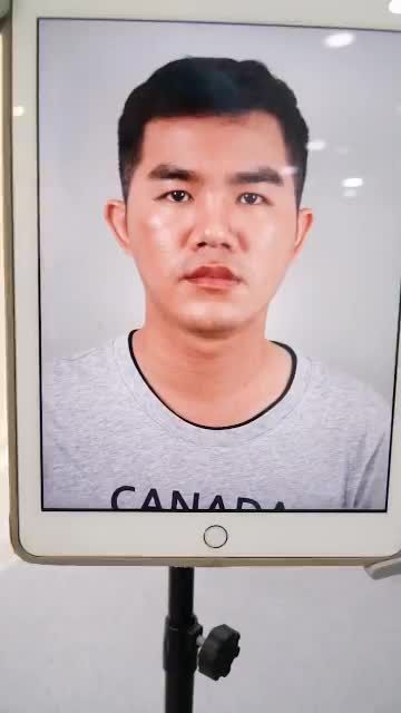 NÂNG MŨI CẤU TRÚC CHO NAM – MŨI ĐẸP CHUẨN MEN