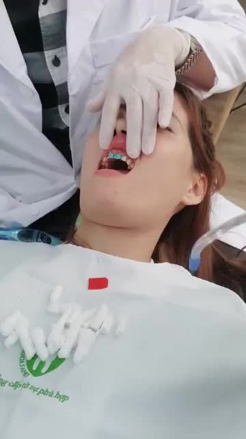 CASE KHÁCH HÀNG DÁN 18 VENEER - Chị Hồng Ngọc