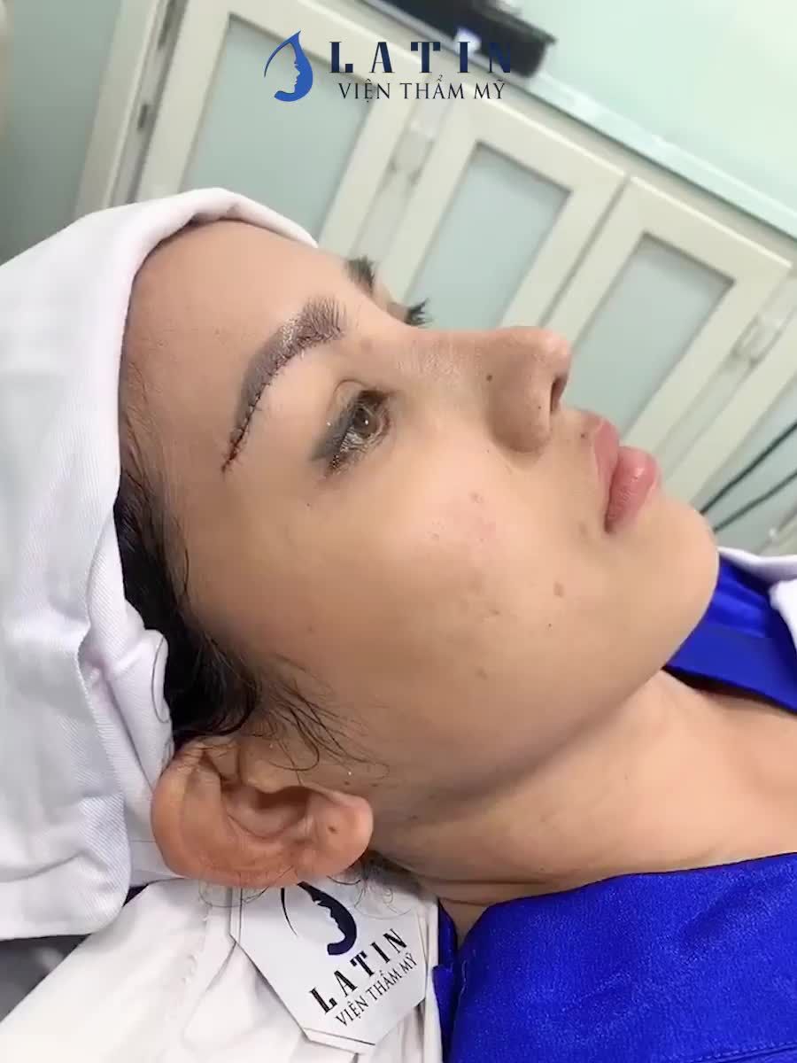 CA NÂNG CUNG MÀY + NÂNG MŨI SỬA LẠI CẤU TRÚC