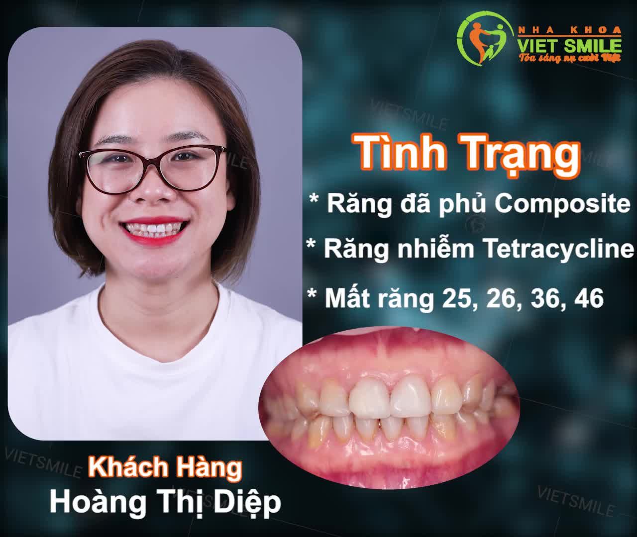 GIẢI PHÁP NÀO PHÙ HỢP CHO TÌNH TRẠNG RĂNG CỦA BẠN