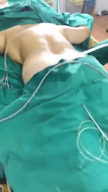 Mỡ Vàng - Mỡ Vàng được loại bỏ bởi vaser lipo với hút mỡ 2 ụ hông và 2 bắp tay