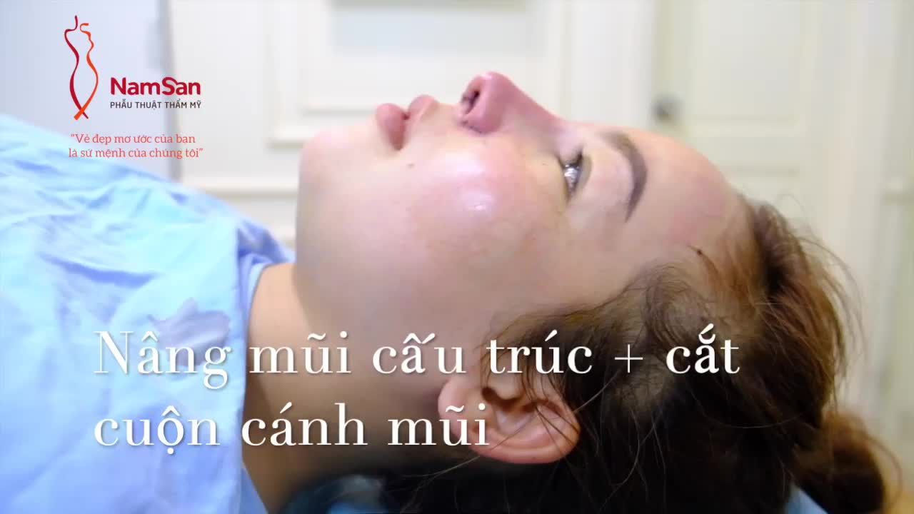 Nâng mũi cấu trúc, kết quả ngay sau mổ