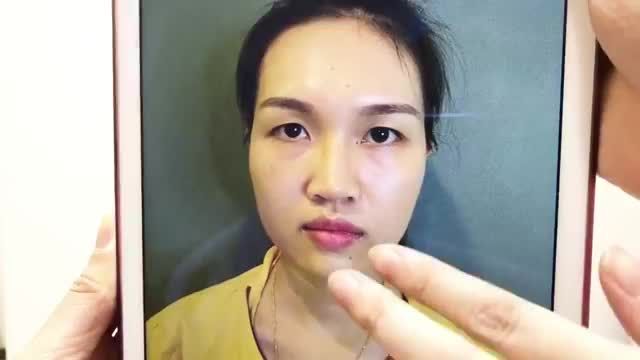 cùng xem sự lột xác sau khi Cắt Mí Mani Mini Deep 5D đẹp hoàn hảo cho vị khách hàng Dr.Hải Lê!