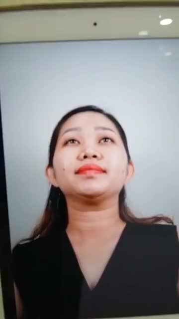 SAU 45P NÂNG MŨI CẤU TRÚC – MŨI ĐẸP THANH TÚ, KHÔNG SƯNG BẦM