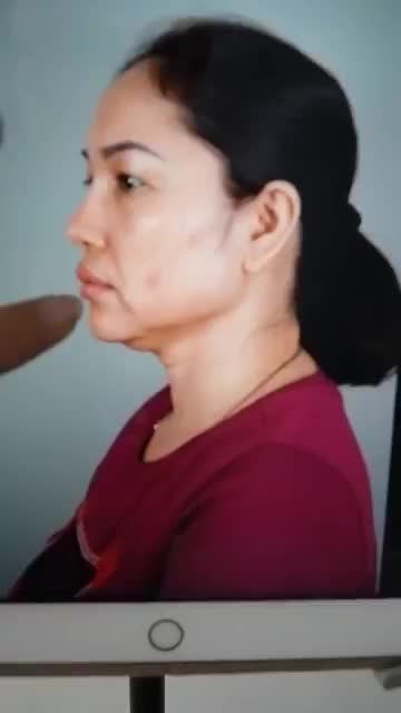 SỬA MŨI HỎNG CHO KHÁCH TỪNG NÂNG MŨI Ở ĐỊA CHỈ KHÁC