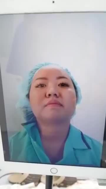 CA NÂNG MŨI CẤU TRÚC KHẮC PHỤC MŨI THẤP TẸT, ĐẦU MŨI NGẮN