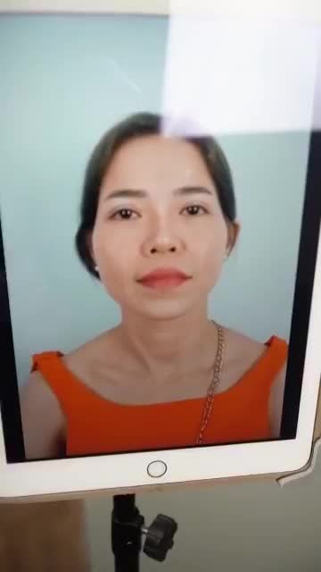 SỬA MŨI HỎNG SAU NÂNG – SAU 10 NGÀY KHÁCH ĐẾN TÁI KHÁM